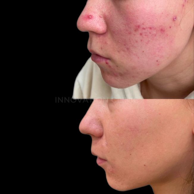 Комплексное лечение акне фото до и после 19