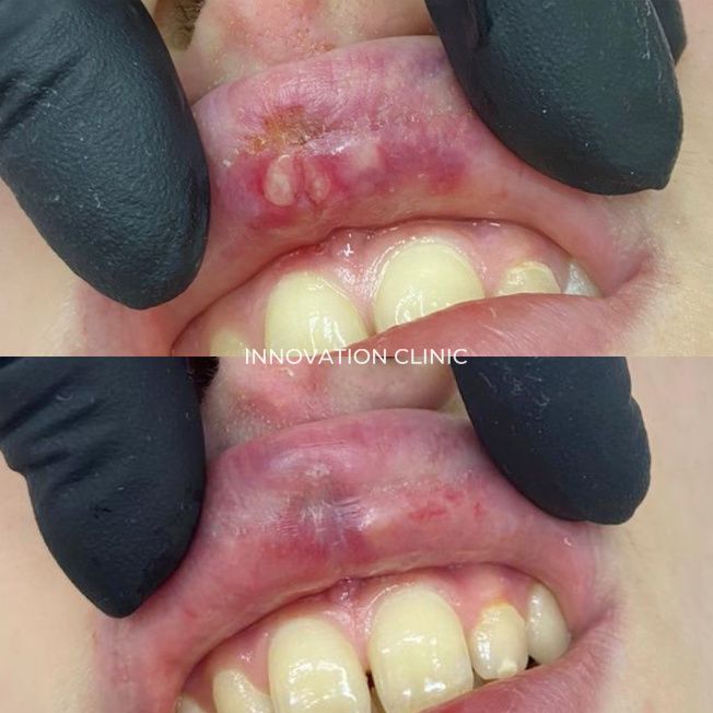 Лечение некроза мягких тканей фото до и после 1