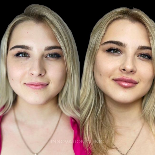 Коррекция формы губ филлером фото до и после 7