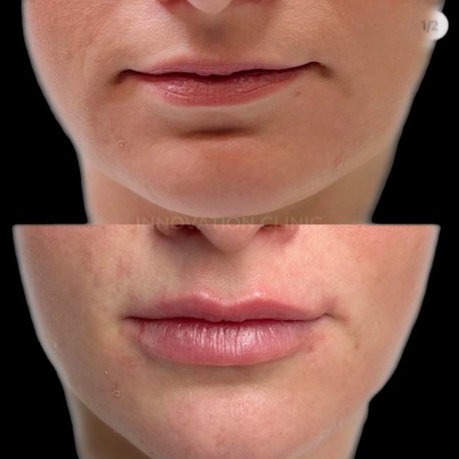 Коррекция формы губ филлером фото до и после 3
