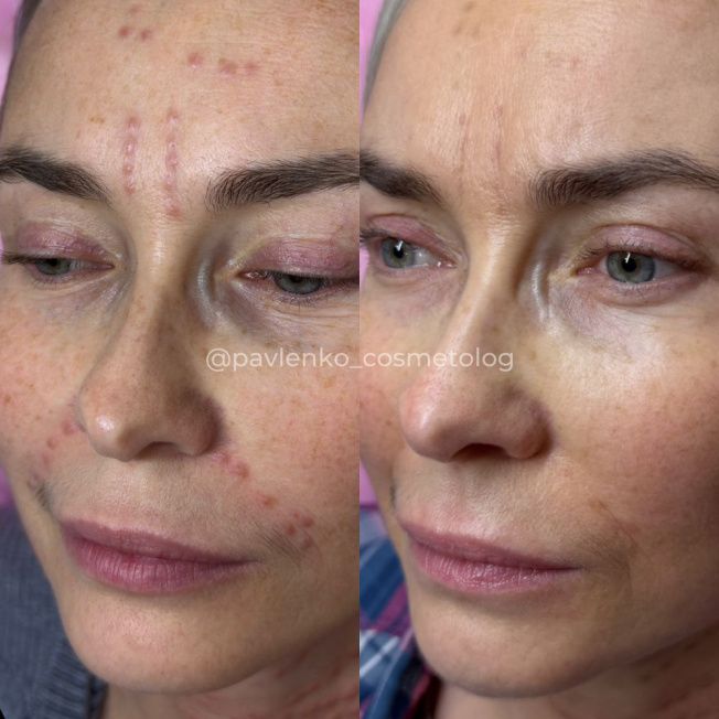 Лечение гранулемы инородного тела