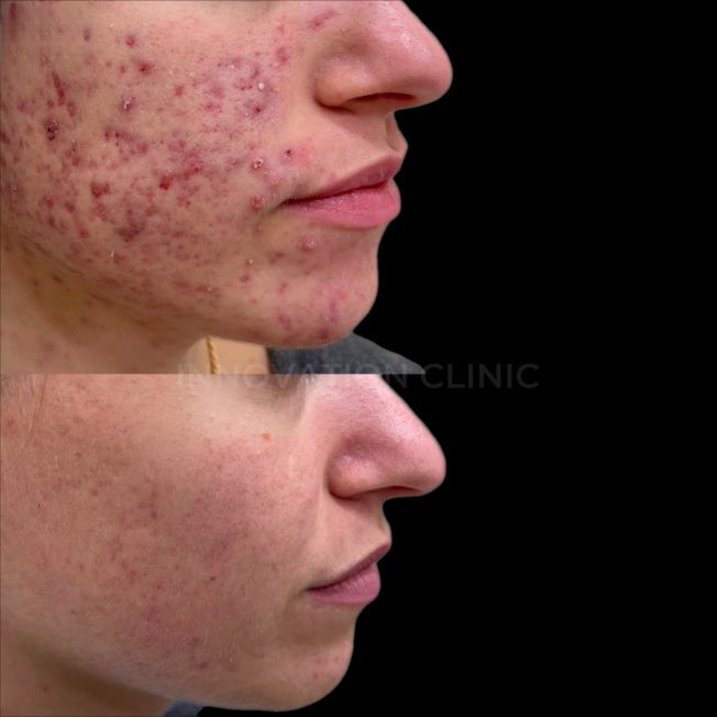 Комплексное лечение акне фото до и после 17