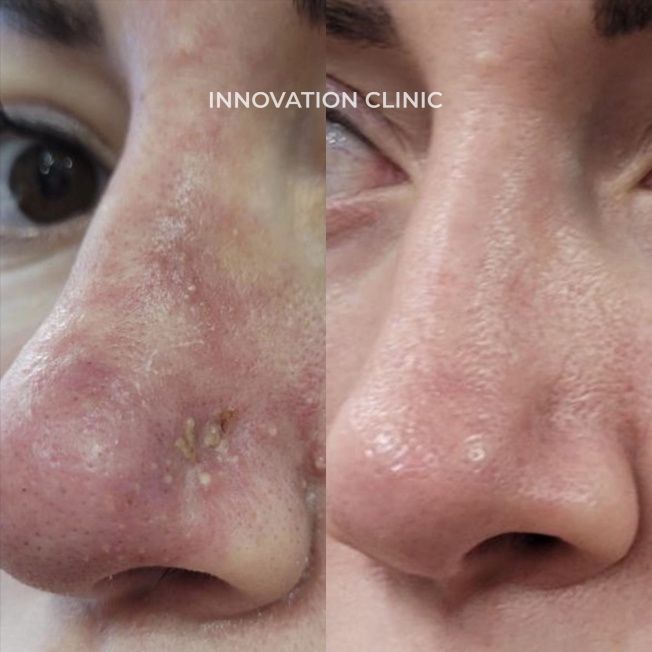 Лечение некроза кожи фото до и после 3