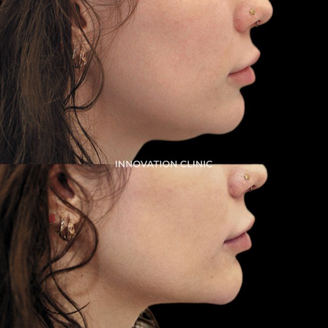 Коррекция подбородка филлером фото до и после 1