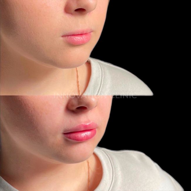 Коррекция формы губ филлером фото до и после 13