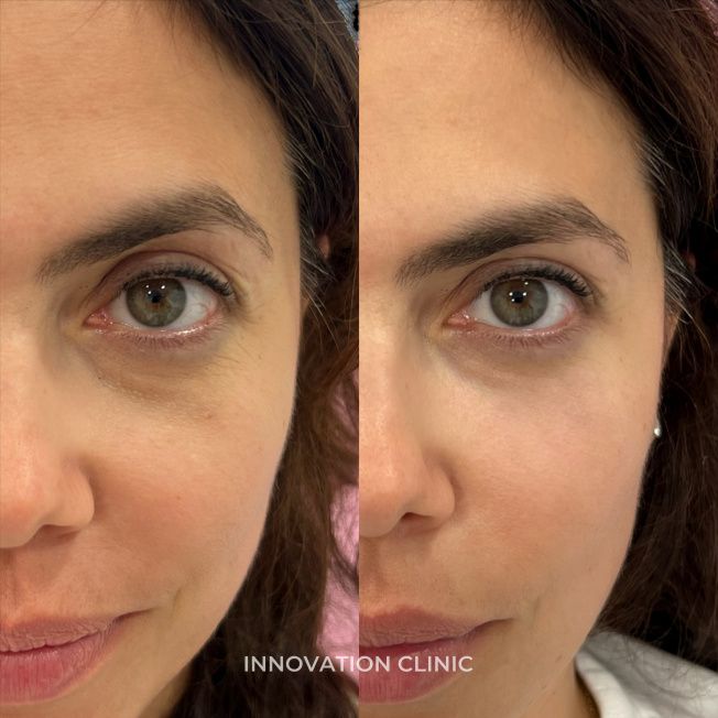 Коррекция носослёзной борозды фото до и после 11