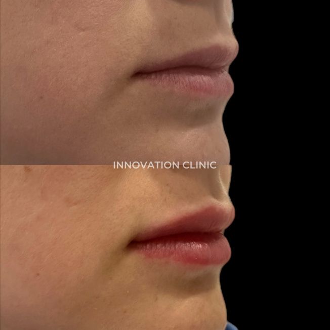 Коррекция формы губ филлером фото до и после 22