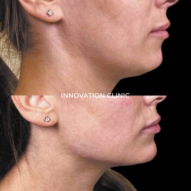 Коррекция нижней трети лица фото до и после 4