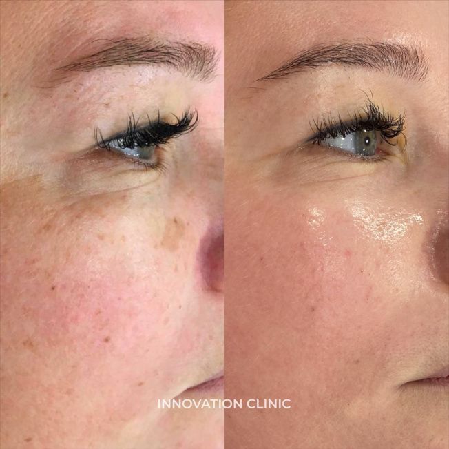 Лечение гиперпигментации кожи фото до и после 3