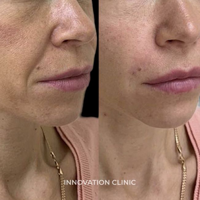 Коррекция носогубных складок фото до и после