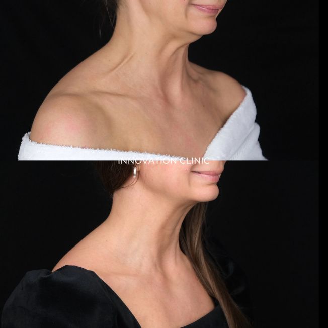 Устранение платизмарных тяжей фото до и спустя 14 дней