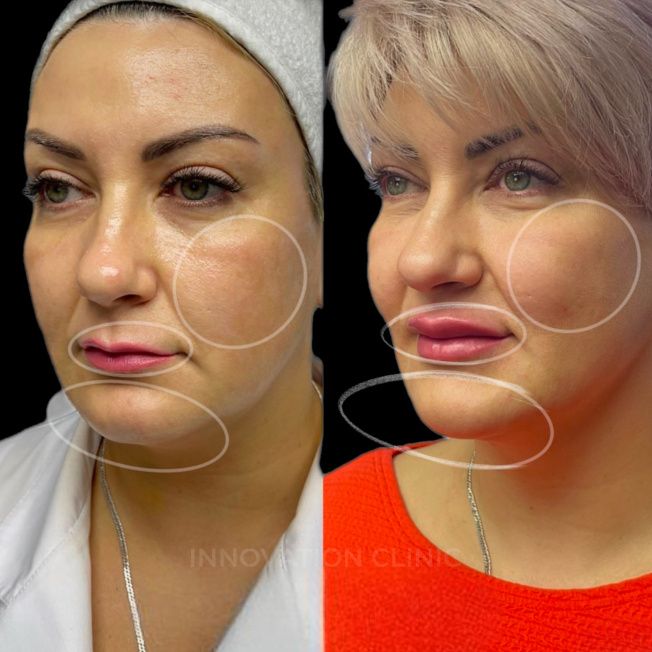 FullFace-коррекция лица филлерами фото до и после 3