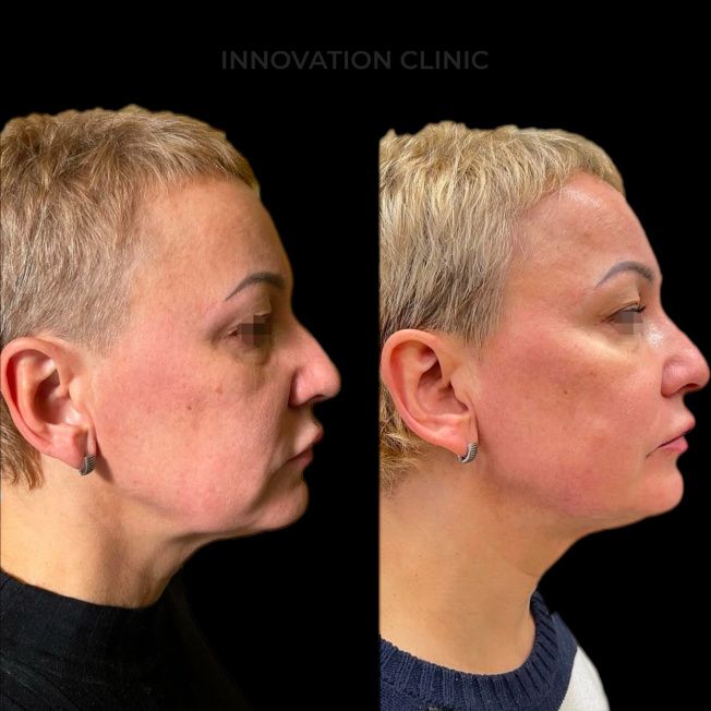 Нитевой лифтинг лица фото до и после 1