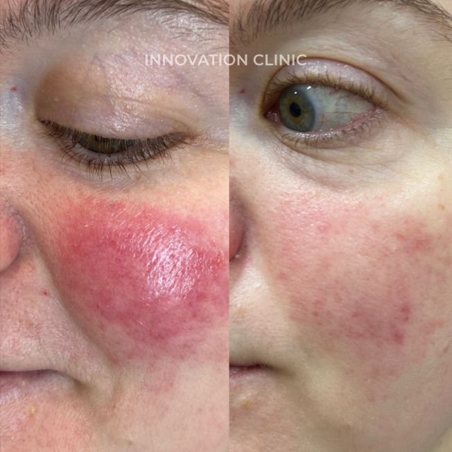 Розацеа на лице