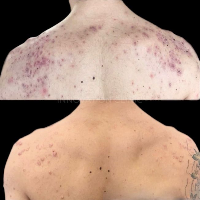 Комплексное лечение акне фото до и после 5