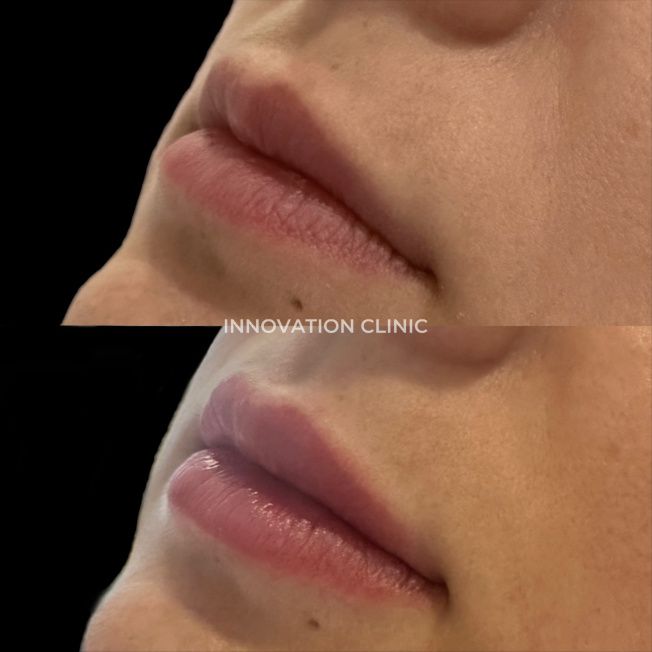 Коррекция формы губ филлером фото до и после 20