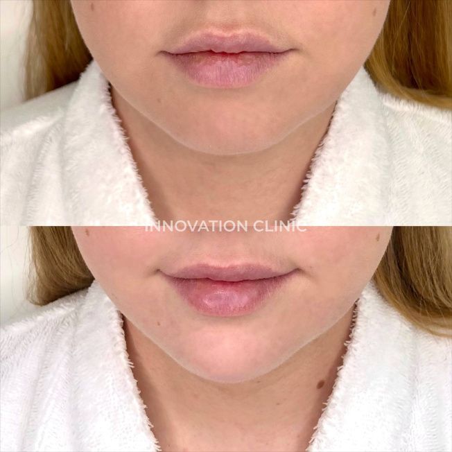 Коррекция подбородка филлером фото до и после 4