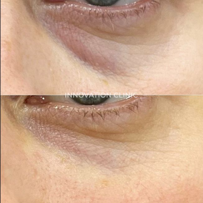 Коррекция носослёзной борозды фото до и после 8