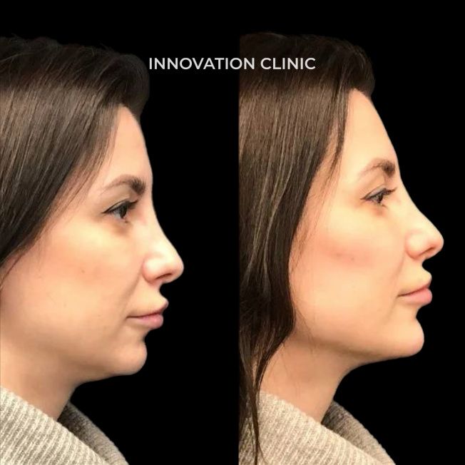 FullFace-коррекция лица филлерами фото до и после 2 