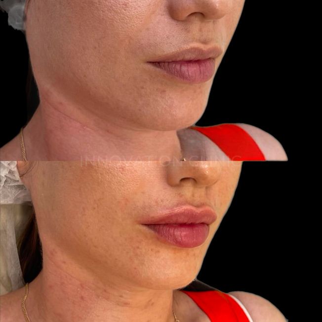 Коррекция формы губ филлером фото до и после 1