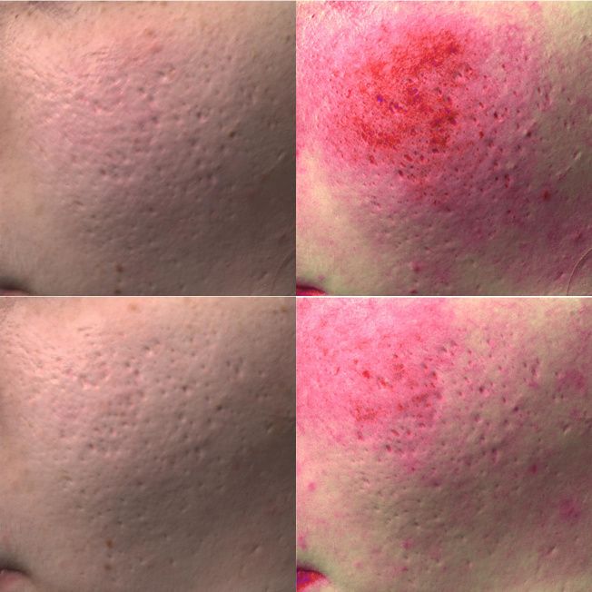 Биореструктуризация препаратом ARES Dermo Restructurant фото до и после