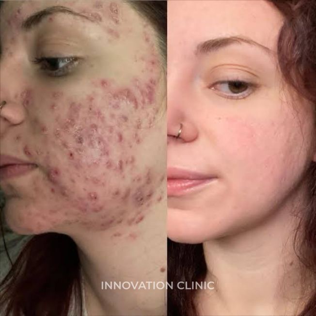 Комплексное лечение акне фото до и после 12