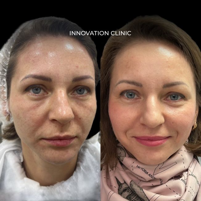 результат после 1 процедуры микроигольчатого RF-лифтинга