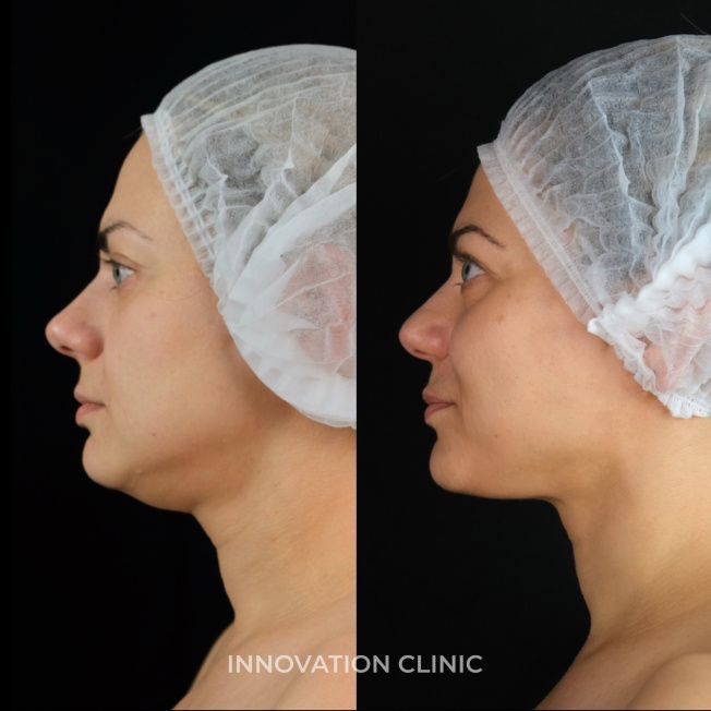 Процедура VOLFORMER фото до и после 1