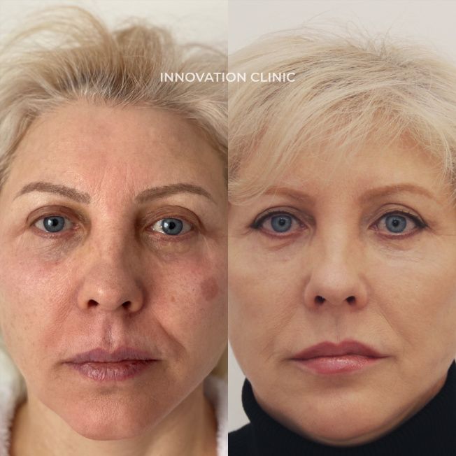 Лазерная шлифовка лица фото до и после 3