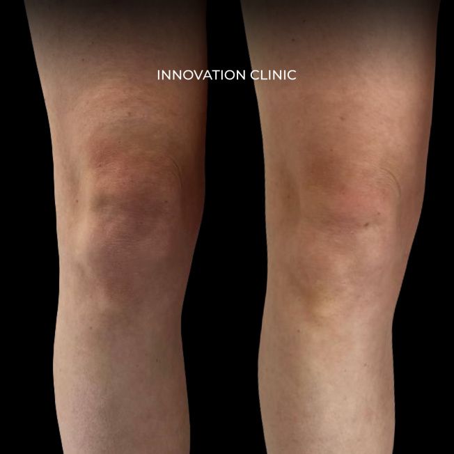 Микроигольчатый РФ-лифтинг коленей Morpheus 8