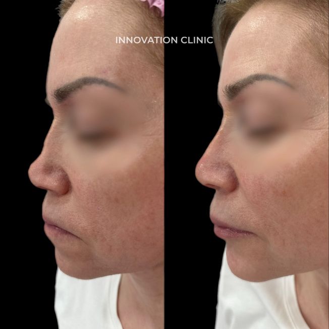 Коррекция спинки носа филлером фото до и после 5