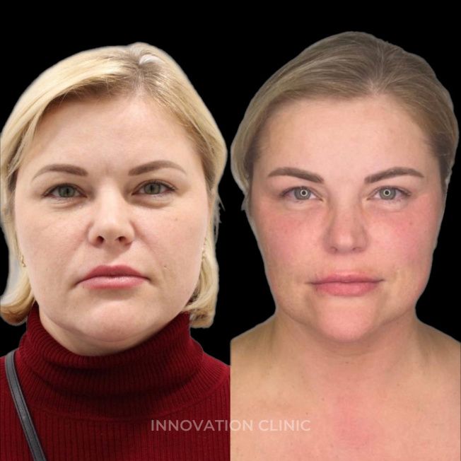 УЗ SMAS-лифтинг средней трети лица фото до и после