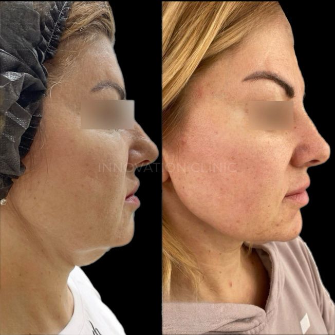 УЗ SMAS-лифтинг нижней трети лица фото до и после 3