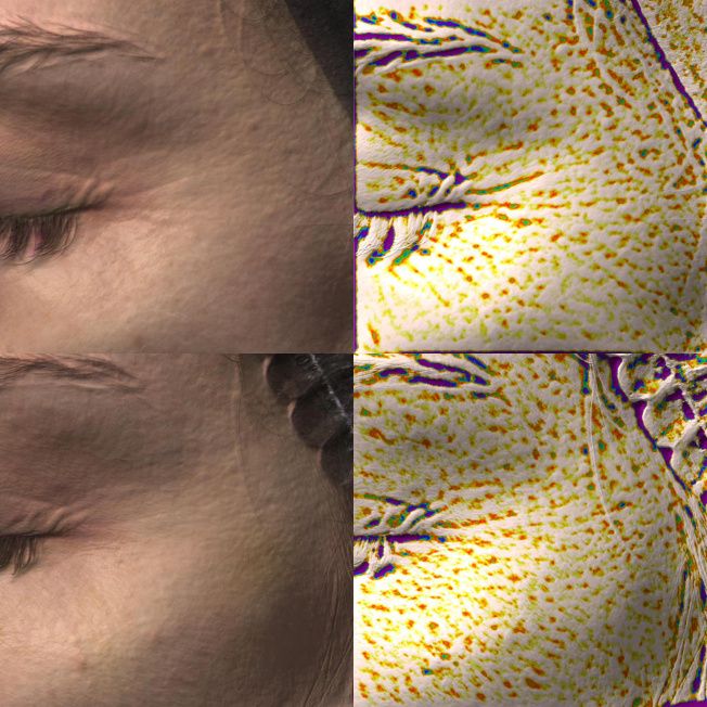 Биореструктуризация препаратом ARES Anti-Age фото до и после 5