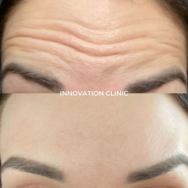 Устранение мимических морщин лба фото до и после