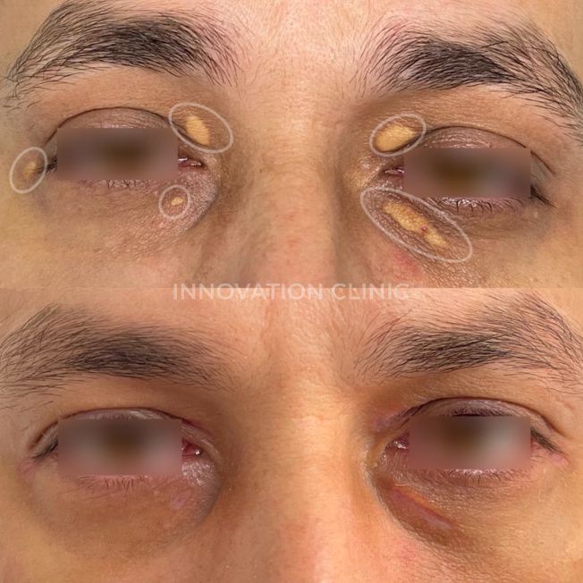 Удаление ксантелазмы фото до и после