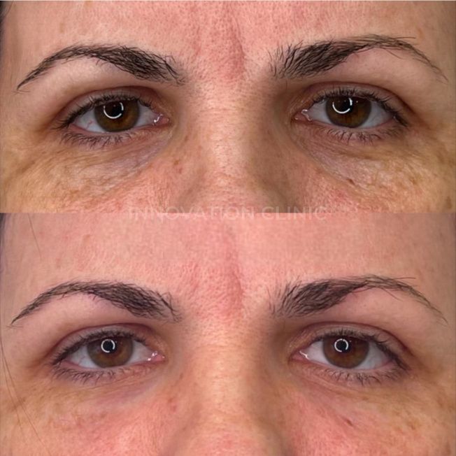 Коррекция носослёзной борозды фото до и после 10