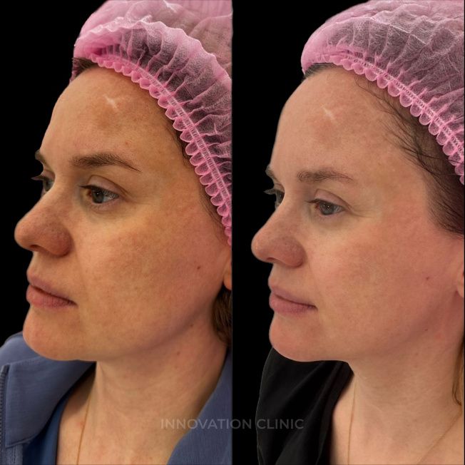 Лечение пигментации фото до и после 2