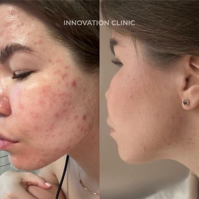 Комплексное лечение акне фото до и после 16