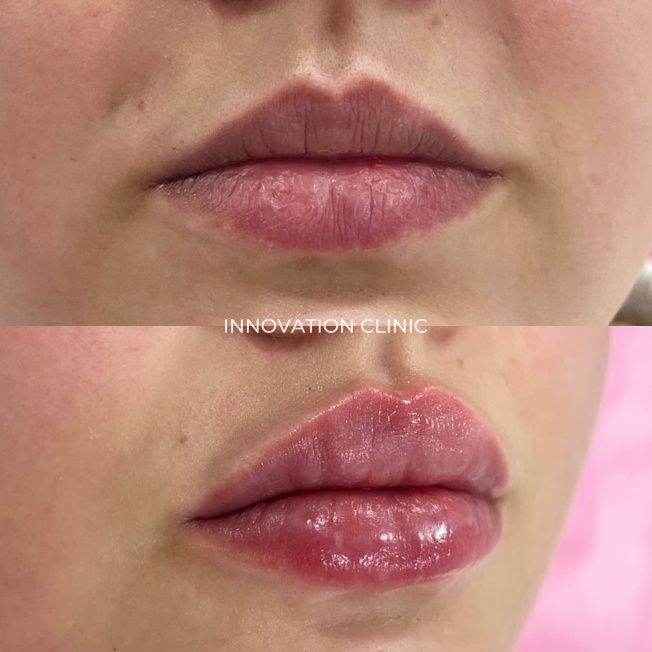 Коррекция формы губ филлером фото до и после 26