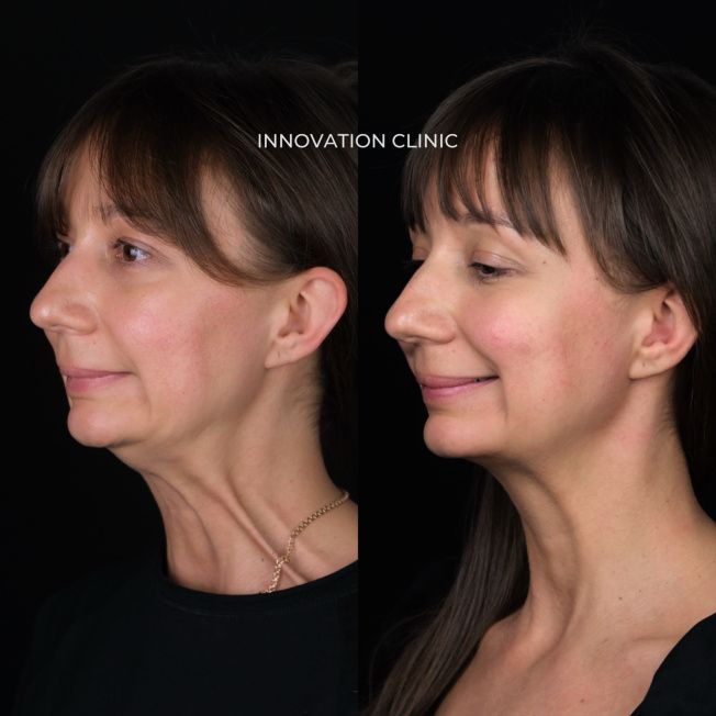 Устранение платизмарных тяжей фото до и спустя 14 дней