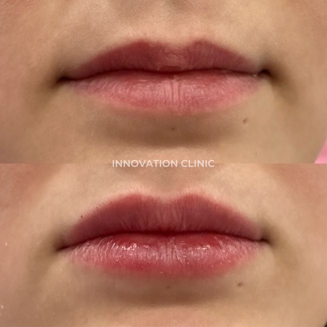 Коррекция формы губ филлером фото до и после 19
