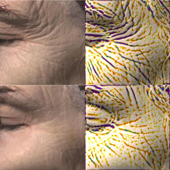 Биореструктуризация препаратом ARES Anti-Age фото до и после 1