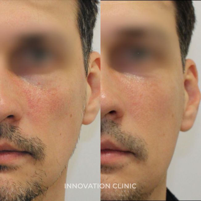 Устранение сосудистых патологий кожи фото до и после 4