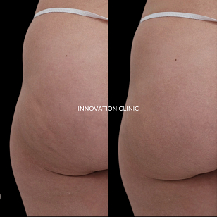 Монополярный RF-лифтинг Volnewmer фото до и после