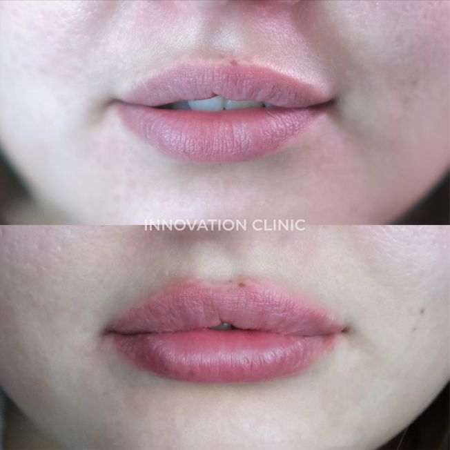 Коррекция формы губ филлером фото до и после 9