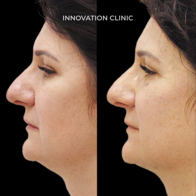 Микроигольчатый RF-лифтинг лица фото до и после 1