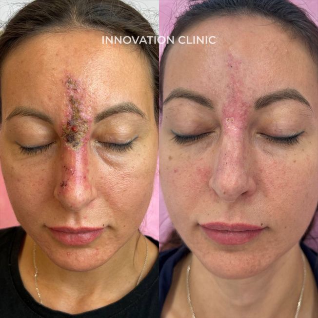 Лечение некроза кожи фото до и после 1