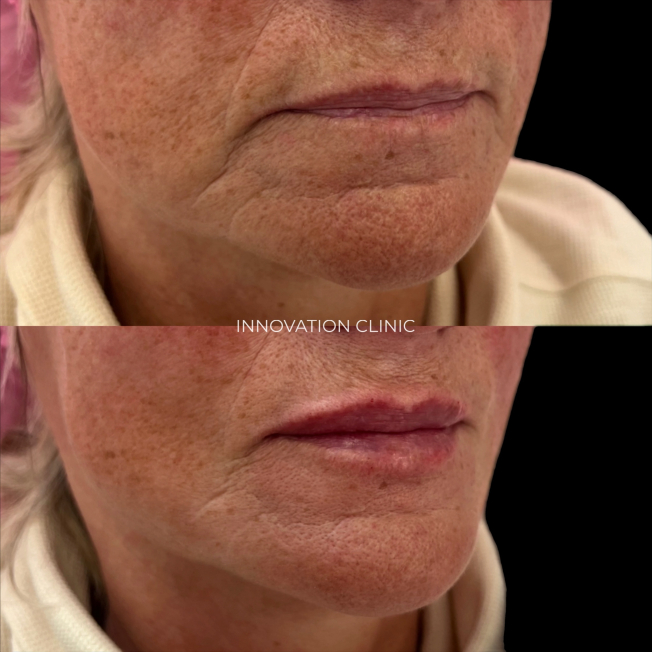 Гармонизация губ