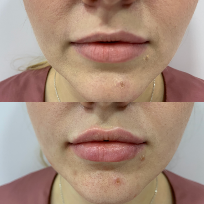 Коррекция формы губ филлером фото до и после 17